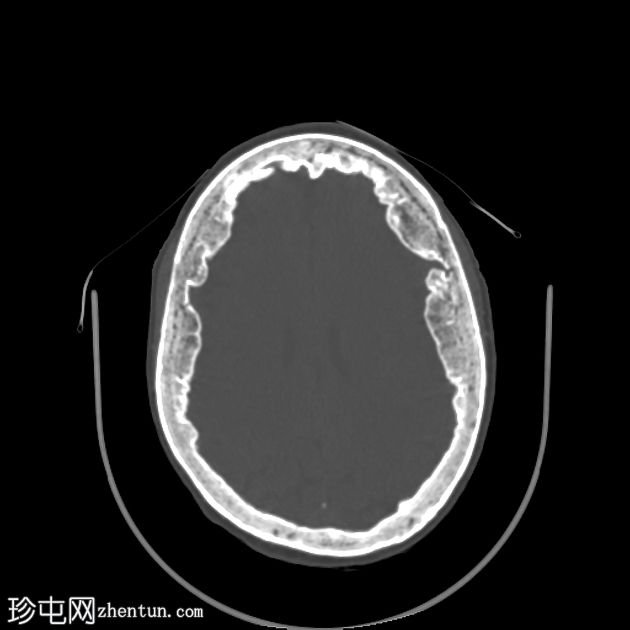 额顶骨质增生