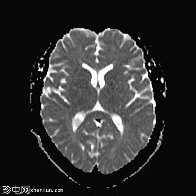 复杂的脑干海绵状瘤及发育性静脉异常