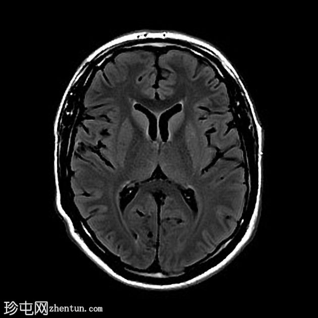 复杂的脑干海绵状瘤及发育性静脉异常