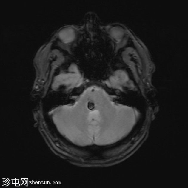 复杂的脑干海绵状瘤及发育性静脉异常