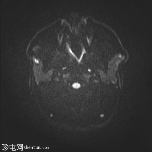 复杂的脑干海绵状瘤及发育性静脉异常