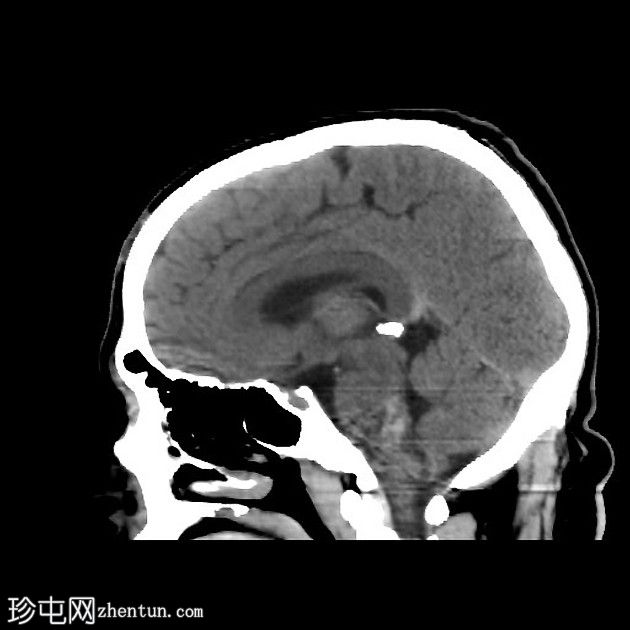 复杂的脑干海绵状瘤及发育性静脉异常