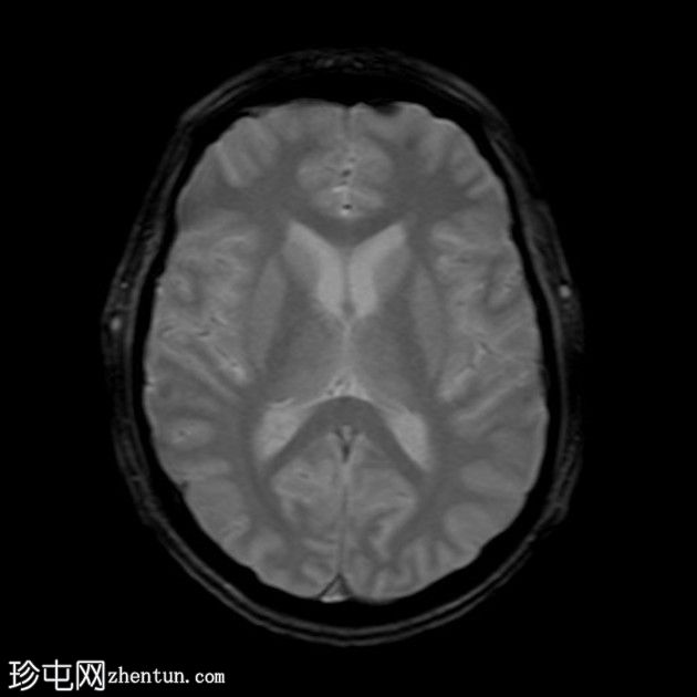 复杂的脑干海绵状瘤及发育性静脉异常