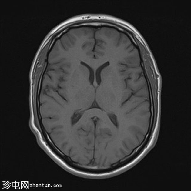 复杂的脑干海绵状瘤及发育性静脉异常