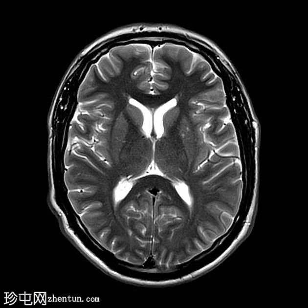 复杂的脑干海绵状瘤及发育性静脉异常