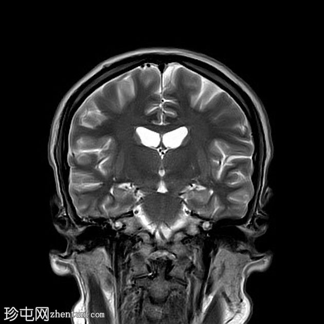 复杂的脑干海绵状瘤及发育性静脉异常