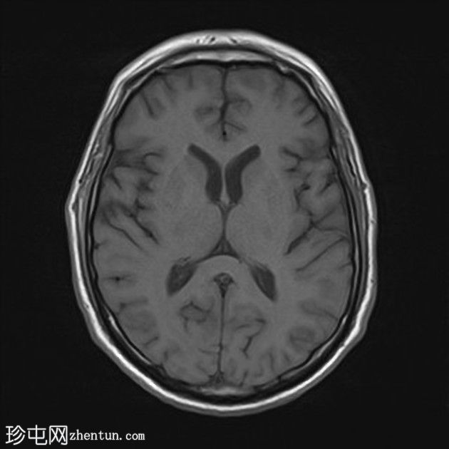 复杂的脑干海绵状瘤及发育性静脉异常