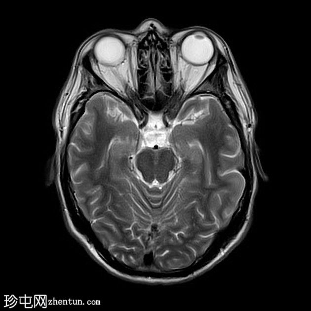 复杂的脑干海绵状瘤及发育性静脉异常