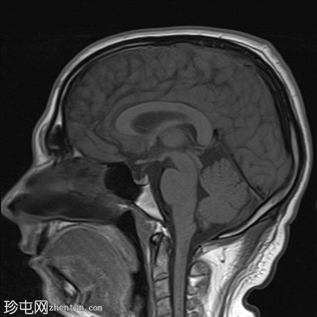 复杂的脑干海绵状瘤及发育性静脉异常