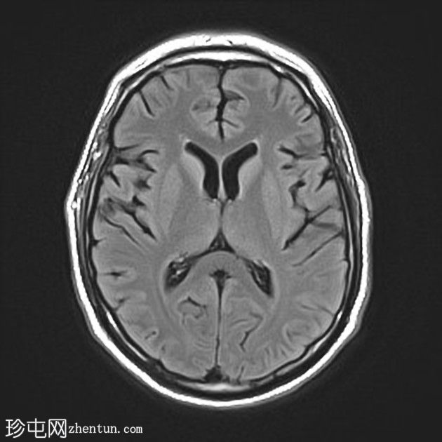 复杂的脑干海绵状瘤及发育性静脉异常