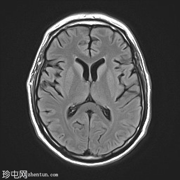 复杂的脑干海绵状瘤及发育性静脉异常