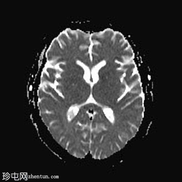 复杂的脑干海绵状瘤及发育性静脉异常