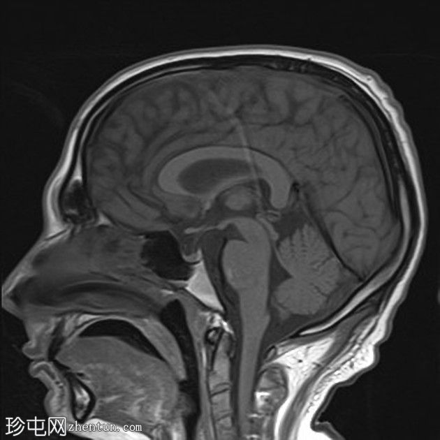 复杂的脑干海绵状瘤及发育性静脉异常