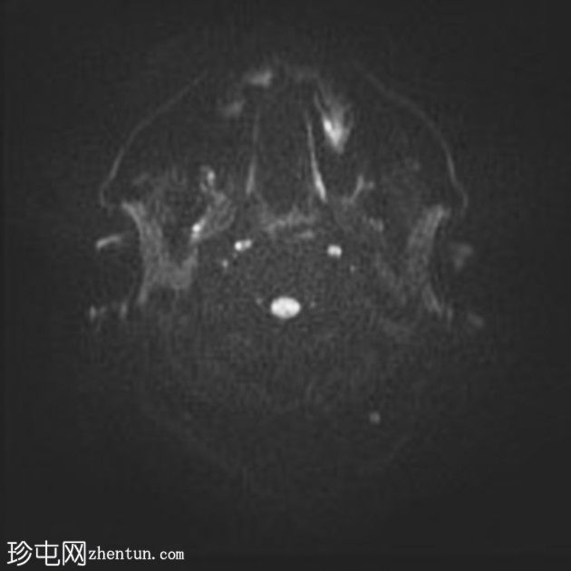 复杂的脑干海绵状瘤及发育性静脉异常