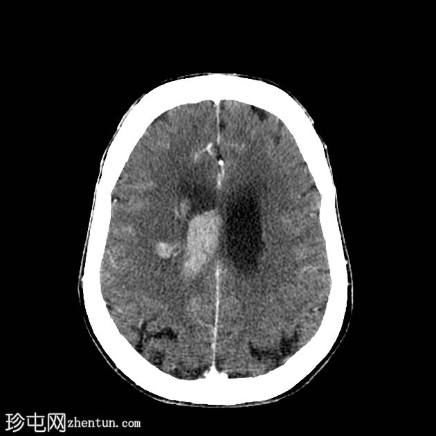 脑血管基底神经节出血