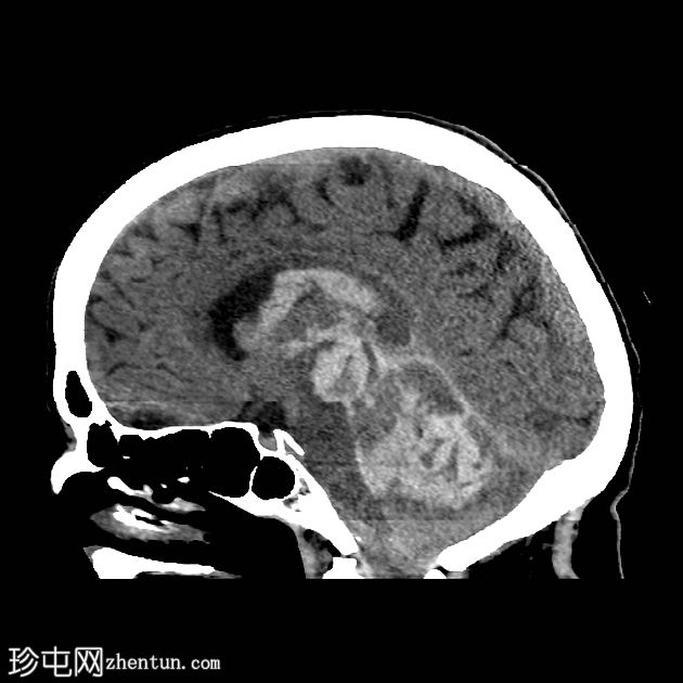 脑血管基底神经节出血