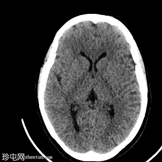 直窦血栓形成(SST)