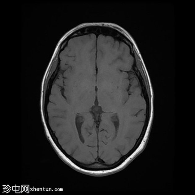 直窦血栓形成(SST)