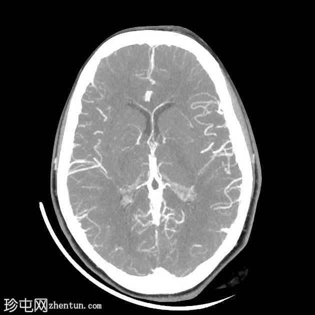 直窦血栓形成(SST)