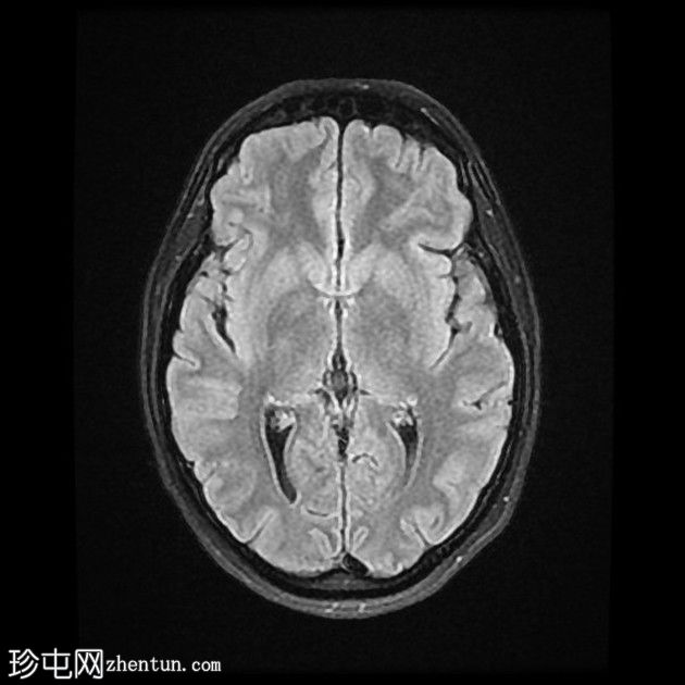 直窦血栓形成(SST)