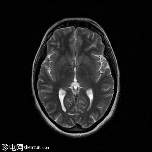 直窦血栓形成(SST)