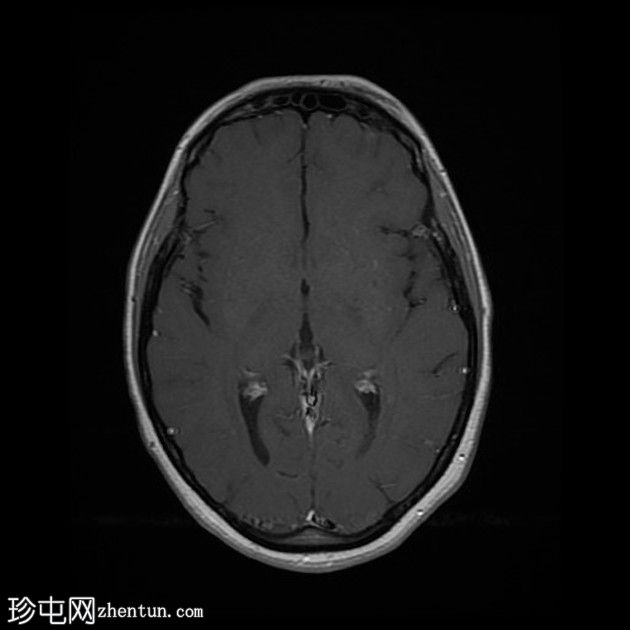 直窦血栓形成(SST)