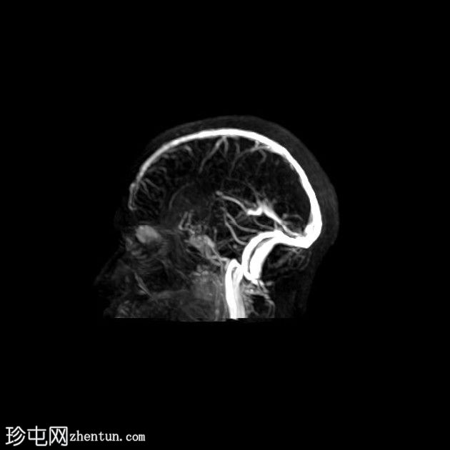 直窦血栓形成(SST)