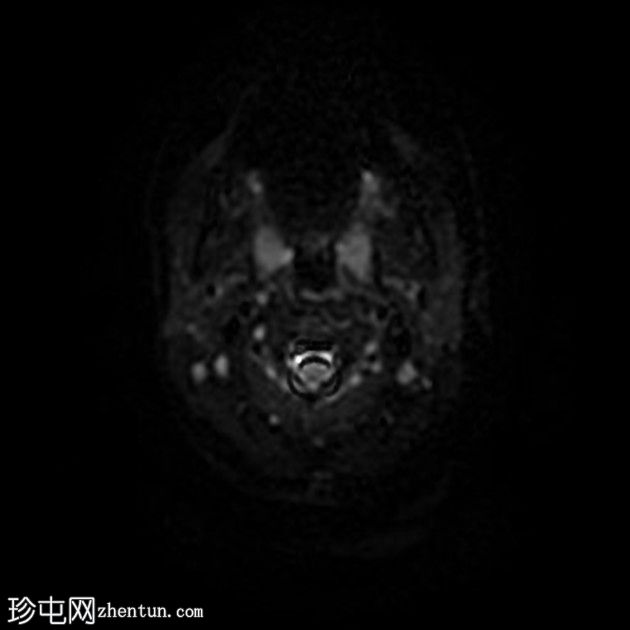 直窦血栓形成(SST)