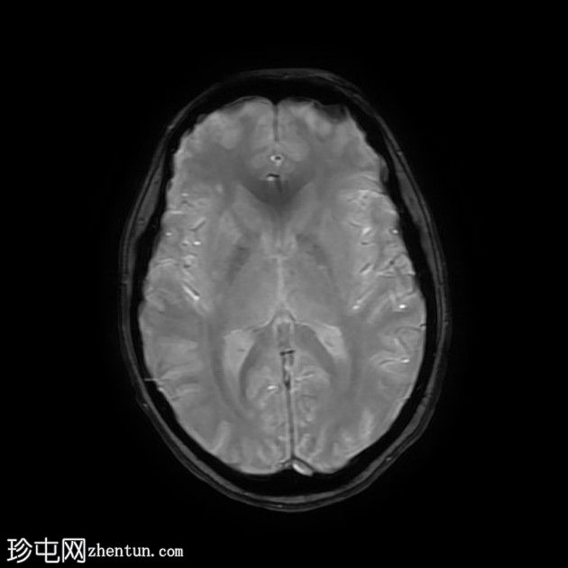 直窦血栓形成(SST)