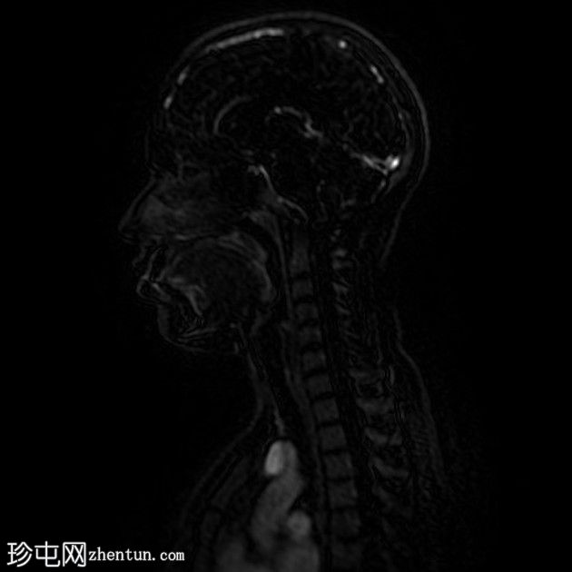 直窦血栓形成(SST)