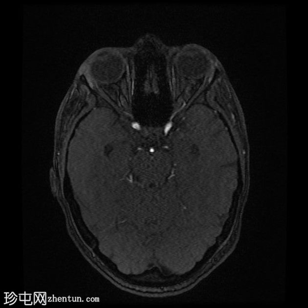 直窦血栓形成(SST)