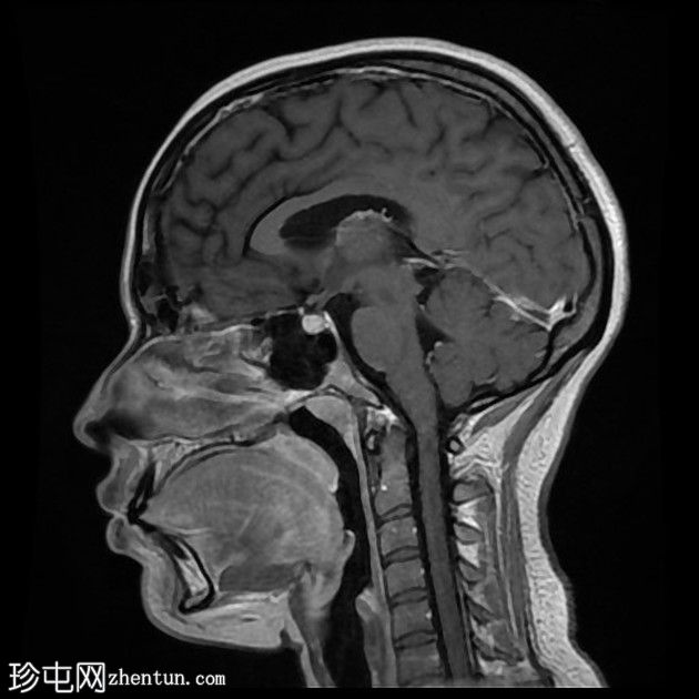 直窦血栓形成(SST)