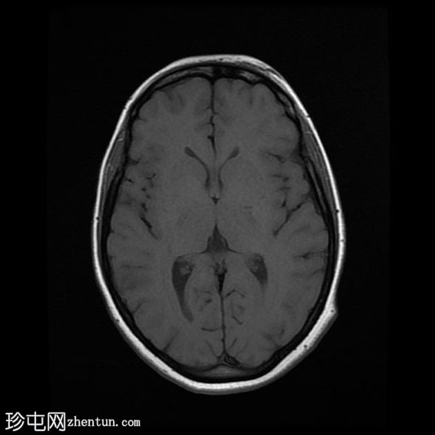 直窦血栓形成(SST)