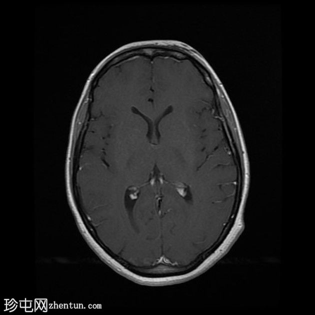 直窦血栓形成(SST)