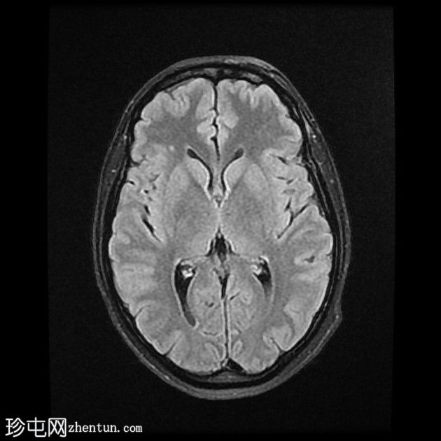 直窦血栓形成(SST)