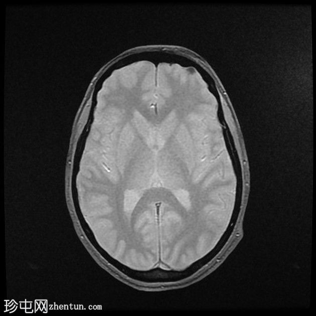 直窦血栓形成(SST)