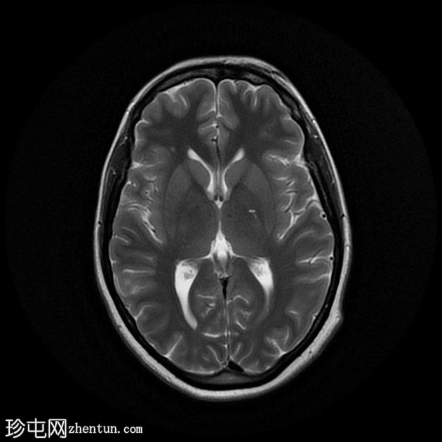 直窦血栓形成(SST)