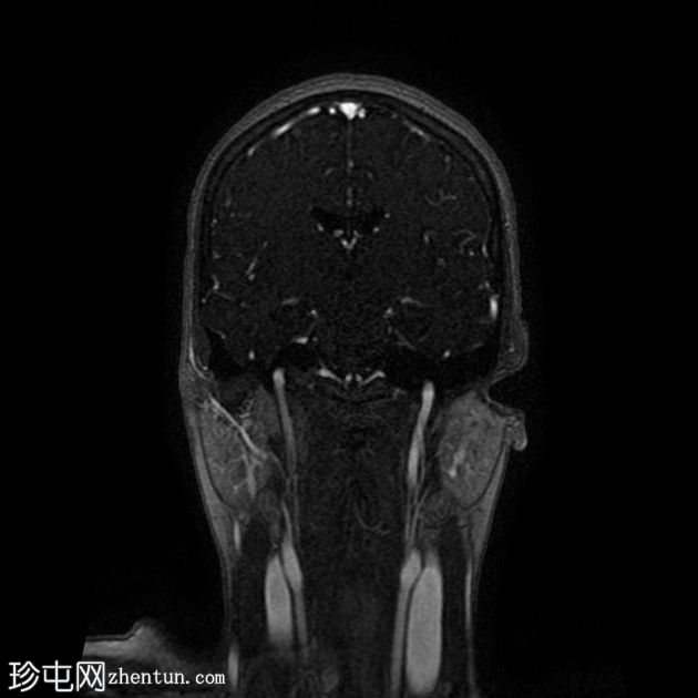 直窦血栓形成(SST)