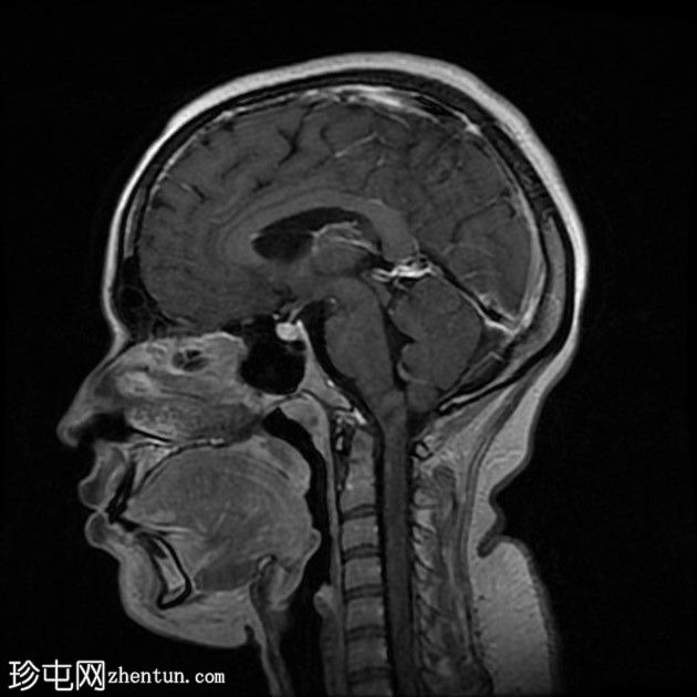 直窦血栓形成(SST)