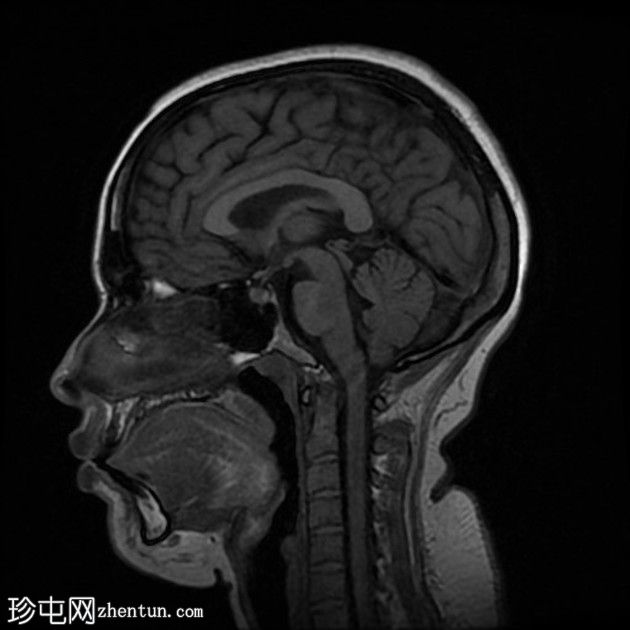 直窦血栓形成(SST)