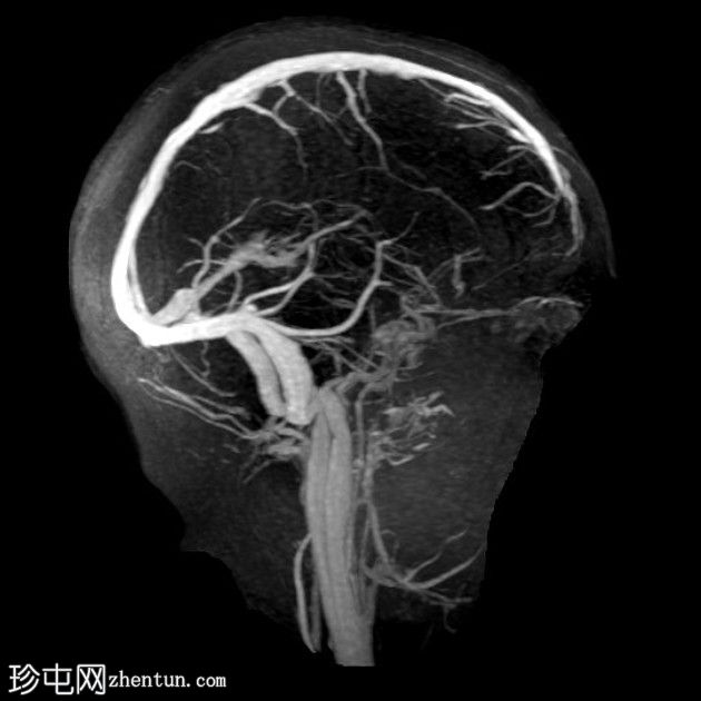 直窦血栓形成(SST)