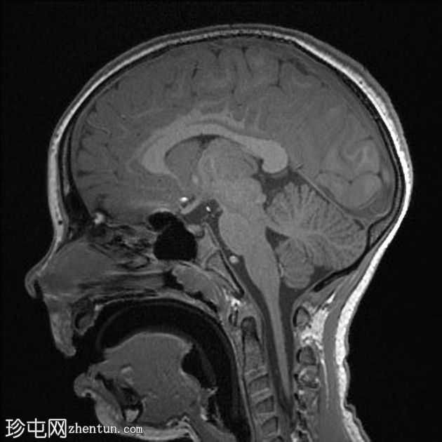 Rasmussen脑炎