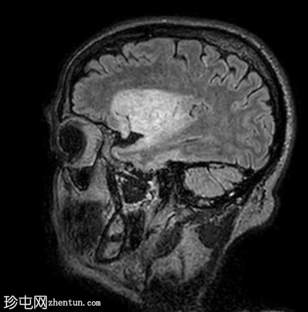 高级别 IDH 突变胶质瘤