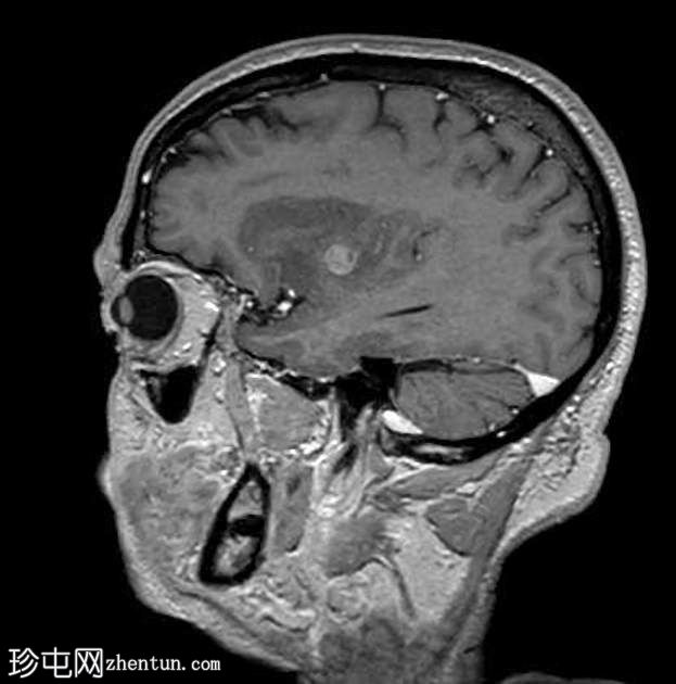 高级别 IDH 突变胶质瘤