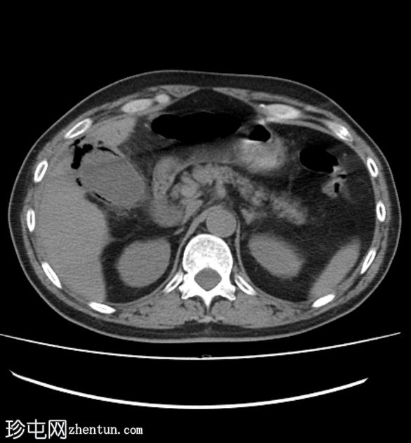 穿孔性气肿性胆囊炎伴继发性腹膜炎