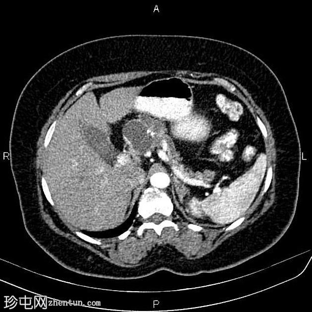 胰腺浆液性囊腺瘤