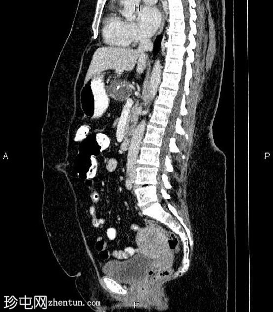 胰腺浆液性囊腺瘤