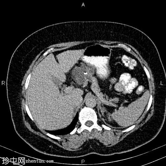 胰腺浆液性囊腺瘤