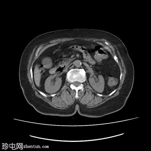 肠憩室梗阻性黄疸综合征（Lemmel Syndrome）