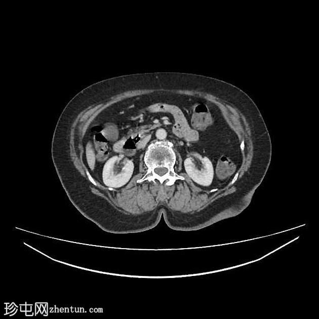 肠憩室梗阻性黄疸综合征（Lemmel Syndrome）